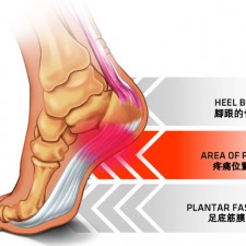 Plantar Fascittis