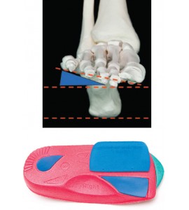 Forefoot Valgus